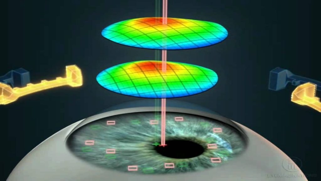 LASIK & Laser Eye Surgery Treatment Procedure & Risks