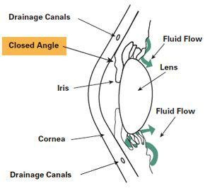 Angle Closure Glaucoma