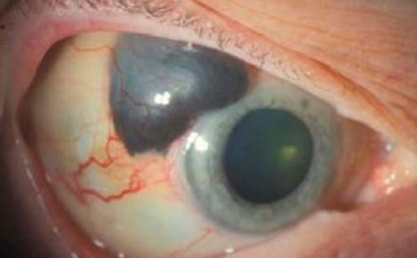 Eye Melanoma